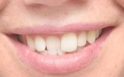 My teeth are crooked and crowded, what options do I have?