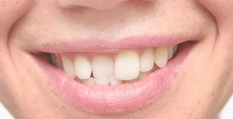 My teeth are crooked and crowded, what options do I have?