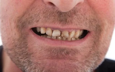 What do I do if I notice I have a cracked tooth?