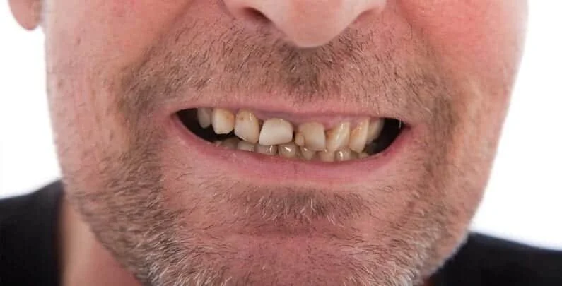 What do I do if I notice I have a cracked tooth?